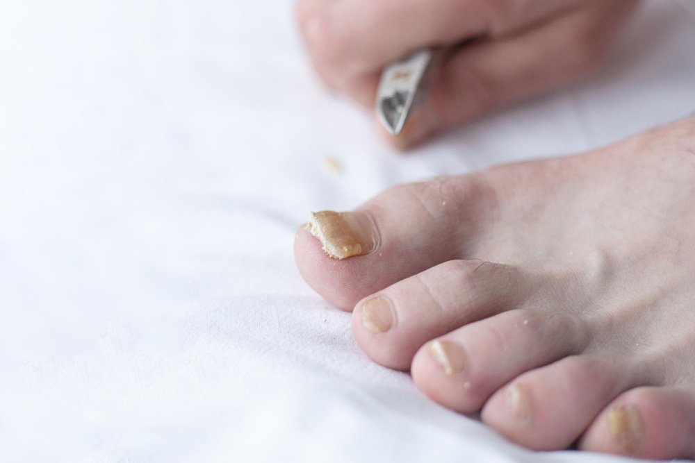 Hongos en las uñas y en cualquier parte del cuerpo en CDMX: diagnóstico y tratamiento
